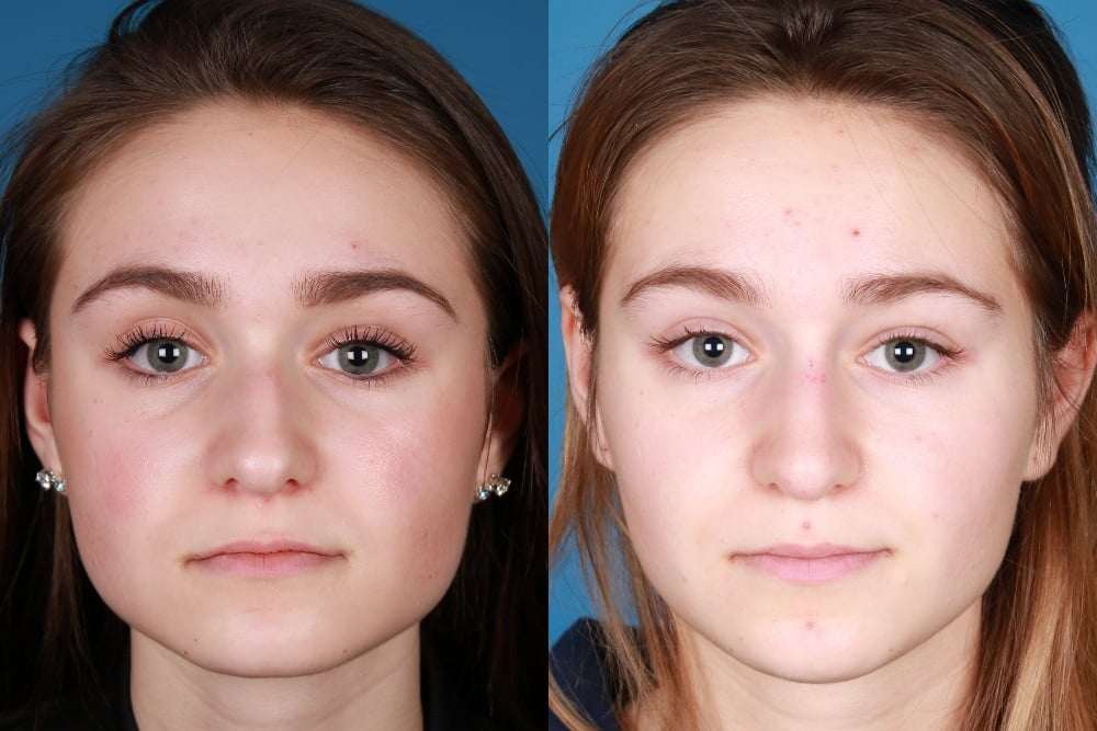 Botox And Fillers Before And Afters Raval Facial Aesthetics Denver